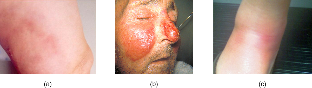 a) a red rash. B) swollen, red regions on the cheeks and nose. C) red lumps on the skin.