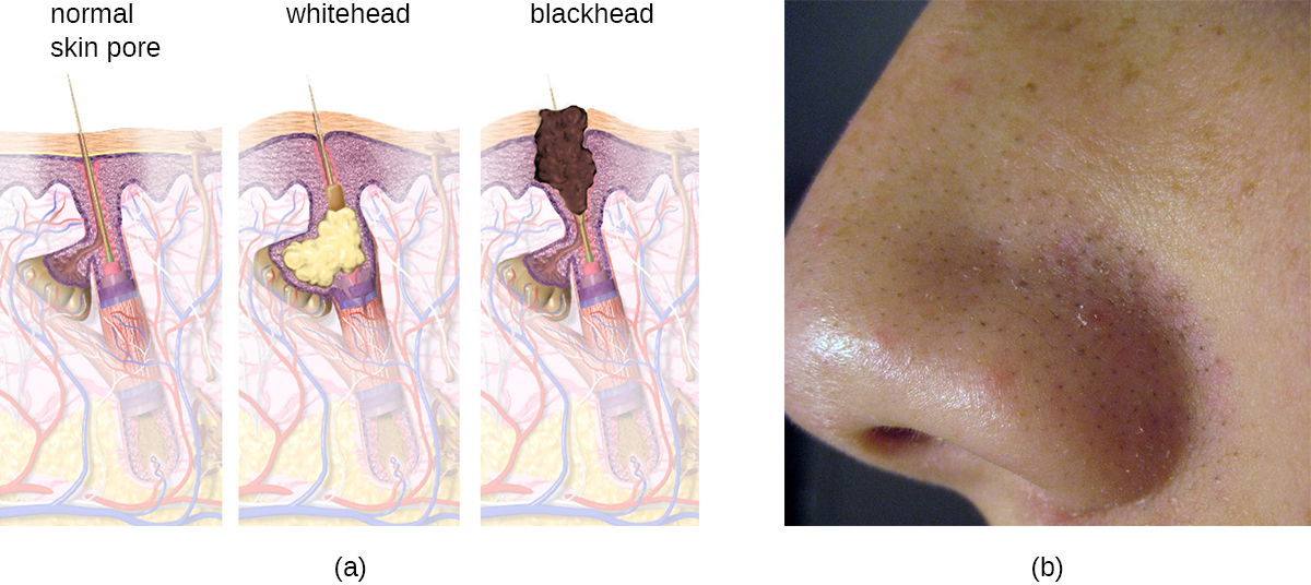 a) diagrama de formación de puntos negros. Un poro normal en la piel se llena de material formando una mancha blanca. El material más oscuro forma una espinilla. B) puntos negros en una nariz.
