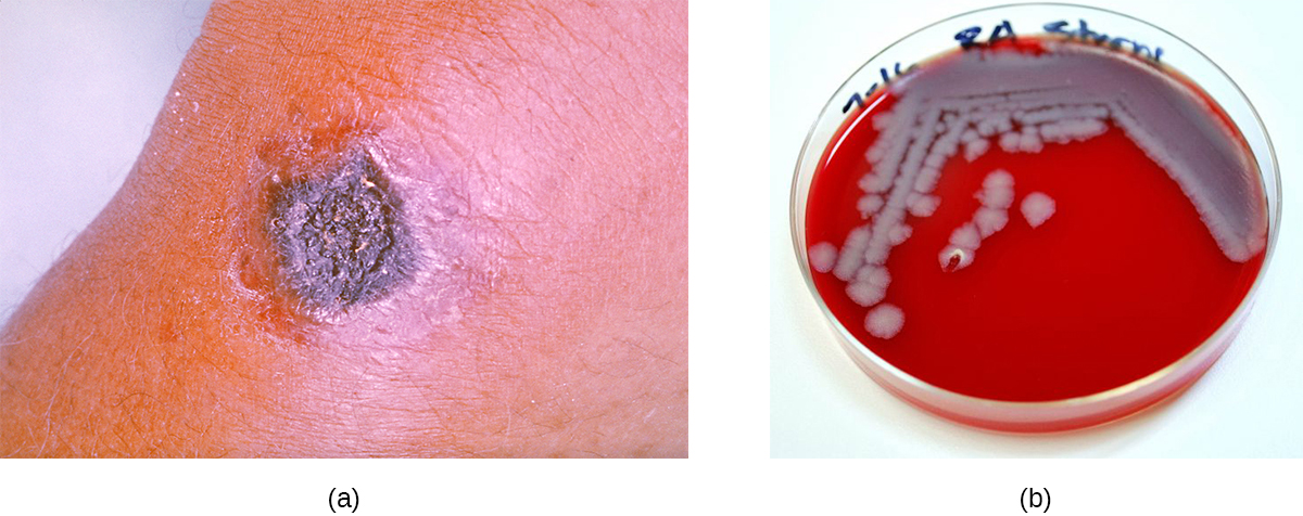 a) Un nódulo negro sobre la piel. b) Una placa roja con colonias grises.