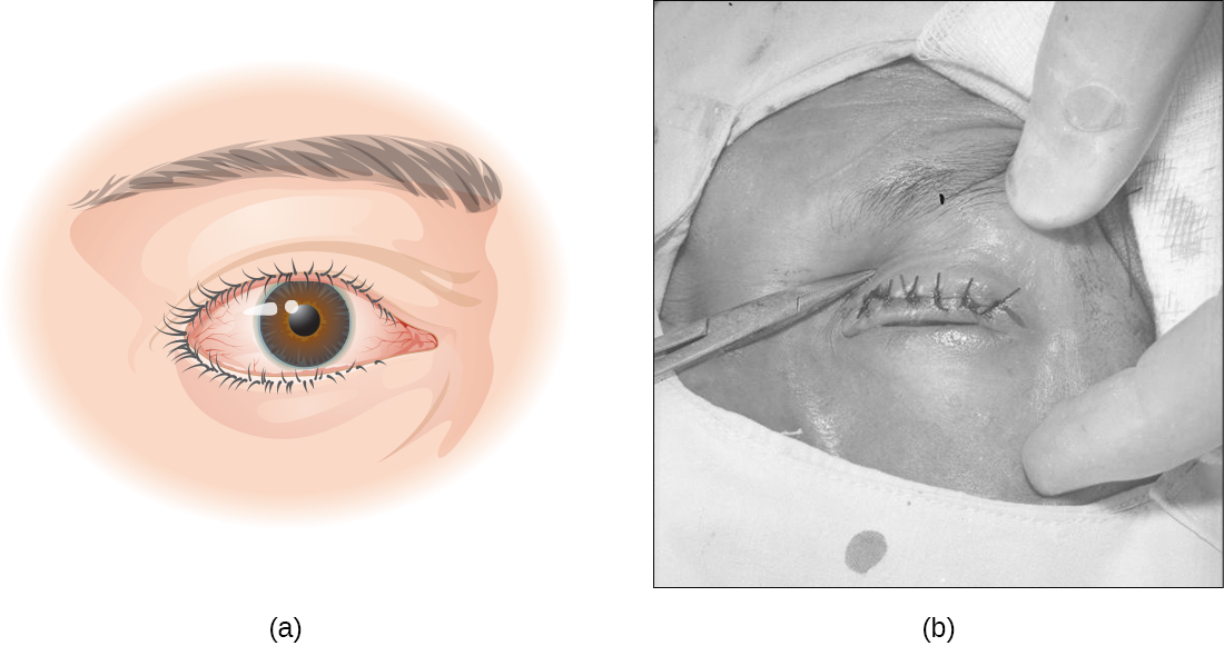 a) ojo con párpados girados. B) foto de cirugía ocular.