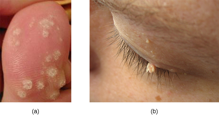 a) photo of warts on a toe. B) photo of wart on an eye.