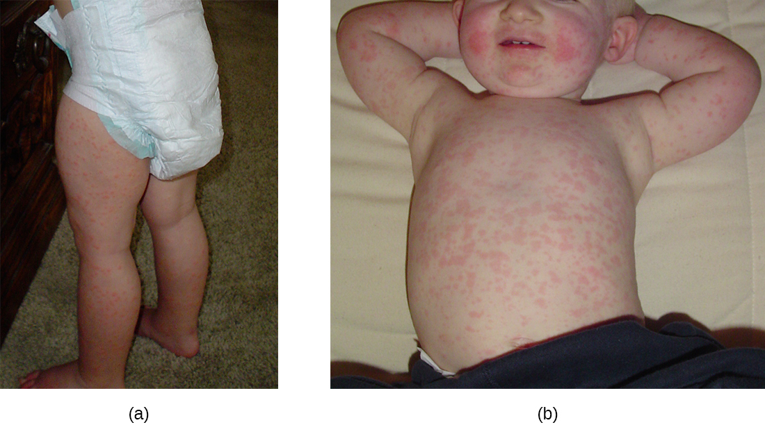 a) foto de manchas rojas en las piernas de un bebé. B) foto de manchas rojas en el tronco de un niño.