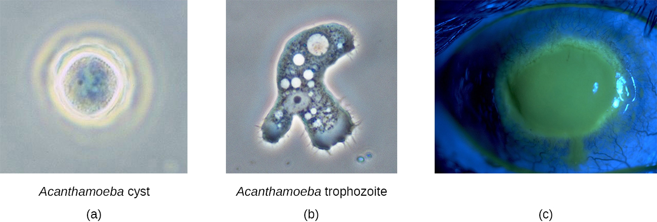 a) se muestra un quiste de acantamoeba. b) se muestra una micrografía de trofozoíto de acantamoeba. c) se muestra una foto de un ojo con córnea fluorescente.