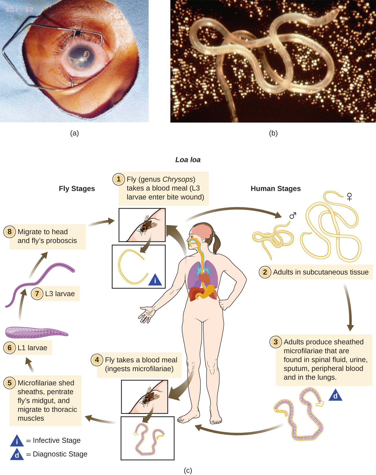 The first part of the image is a photograph of an eye with a visible worm inside of it and a photo of a close-up of the worm. The second image is a illustrated chart showing the Life cycle of Lao lao. Fly (genus Chrysops) takes a blood meal (L3 larvae enter the bite wound). Adults grow into long worms in the subcutaneous tissue. Adults produce sheathed microfilariae that are found in spinal fluid, urine, sputum, peripheral blood, and in the lungs. Another fly take a blood meal and ingests microfilariae. The microfilariae shed sheaths, penetrate fly’s midgut, and migrate to thoracic muscles. The L1 larvae forms and becomes an L3 larvae which migrates to the head and fly’s proboscis. The fly is now ready to infect another person