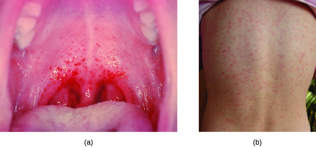 bright red inflammation at the back of the mouth.