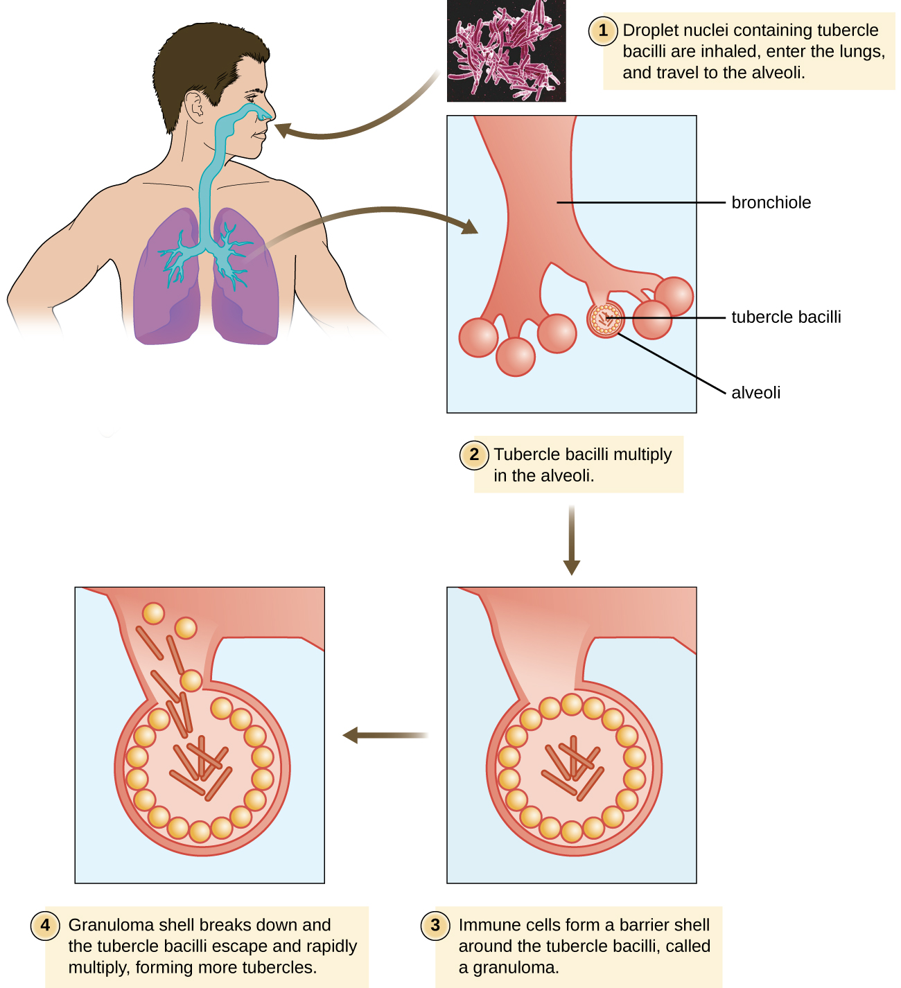 Diagram showing infectious cycle of tuberculosis. First a droplet nuclei containing tubercle bacilli are inhaled, enter the lungs and travel to the alveoli. Next, the tubercle bacilli multiply in the alveoli. Next, the immune cells form a barrier shell around the tubercle bacilli, called a granuloma. Finally, the granuloma shell breaks down and the tubercle bacilli escape and rapidly multiply forming more tubercles.