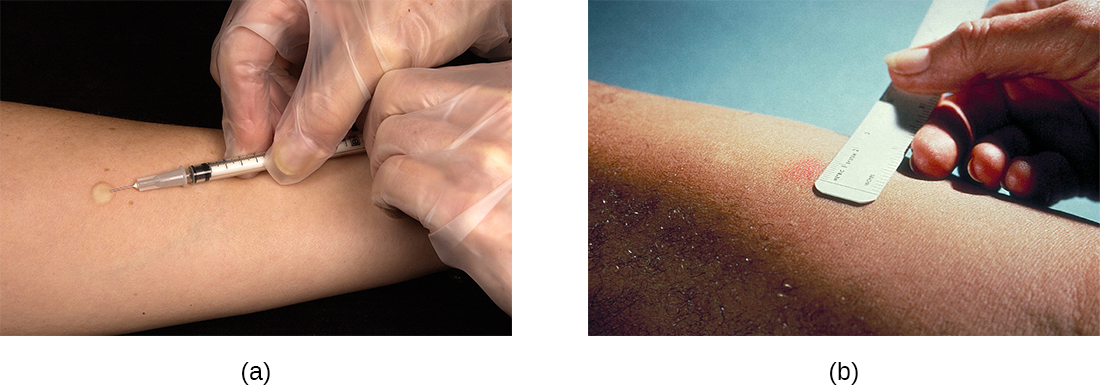 a) a needle injects a small bubble into a person’s skin. B) a ruler is used to measure a red area on a person’s skin.