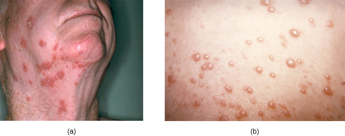 a) Large red spots on an adult’s neck. B) Red bumps on skin.