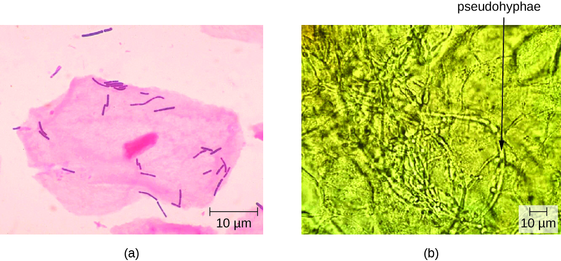 a) micrograph ya kiini kikubwa cha pink na kiini na seli ndogo za fimbo za pink. B) Micrograph ya zilizopo ndefu zilizoitwa pseudohyphae.