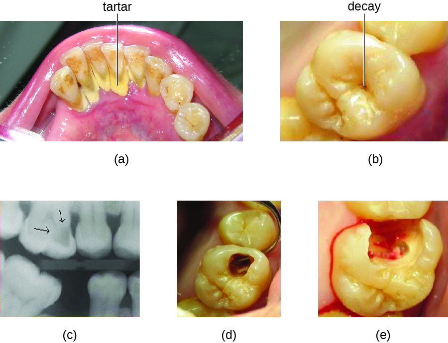 A) photo of a tooth with a dark spot labeled decay. B) micrograph of a tooth; dark regions have an arrow. C) photo of a tooth with a hole. D) photo of a tooth with a large, bleeding hole