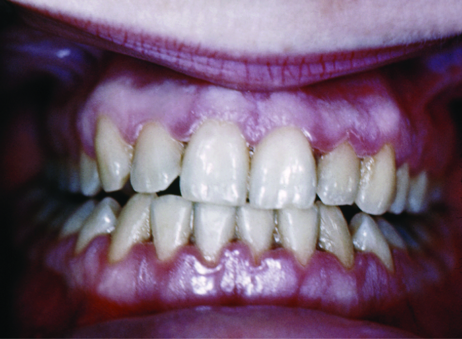 Photo of inflamed gums that have receded showing more of the teeth length.