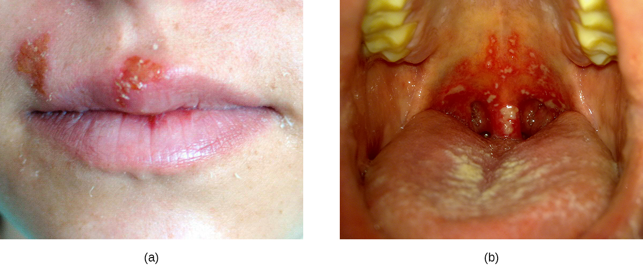 a) photo of a cold sore (red bump) on the lip. B) bumps are present in the back of a person's mouth.