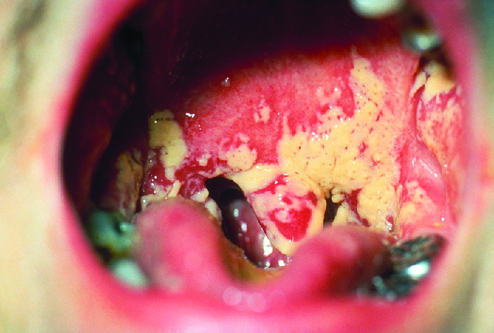 Photo of white lumpy patches in the mouth.