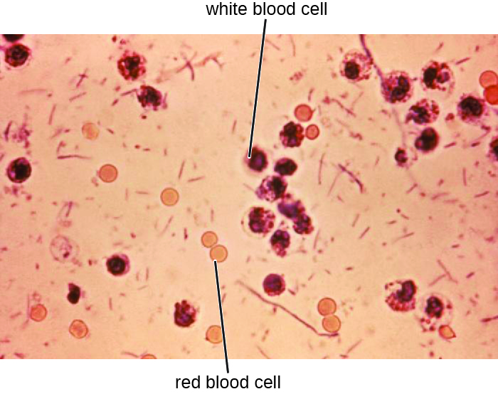 Micrograph of small round red blood cells and larger and darker white blood cells.