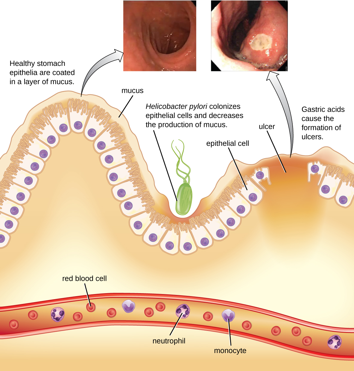A diagram showing the lining of the stomach. At the very bottom is a blood vessel with red blood cells, neutrophils, and monocytes. At the top is a wavy layer of epithelial cells covered in mucous. Healthy stomach epithelia are coated in a layer of mucous. Helicobacter pylori colonizes epithelial cells and decrease the production of mucus. Gastric acids cause the formation of ulcers. Images of a healthy lining show smooth pink regions, an ulcer is seen as wa white spot in the lining.