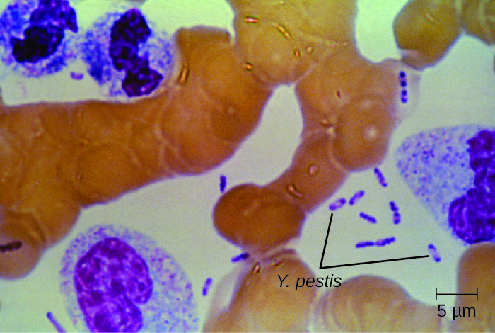 Micrograph kuonyesha ndogo fimbo umbo seli zambarau katika kati ya seli kubwa binadamu. Seli za bakteria za zambarau zina mduara mdogo wazi katikati.