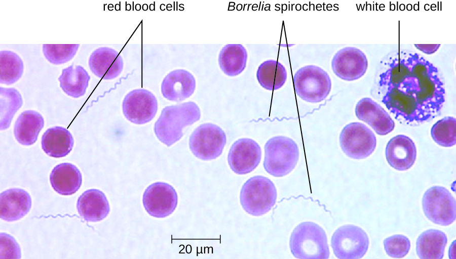 A micrograph showing red circles labeled red blood cells and larger white blood cells. Small spirals (approximately the length of 2 red blood cells; 20 µm) are labeled Borrelia spirochetes.