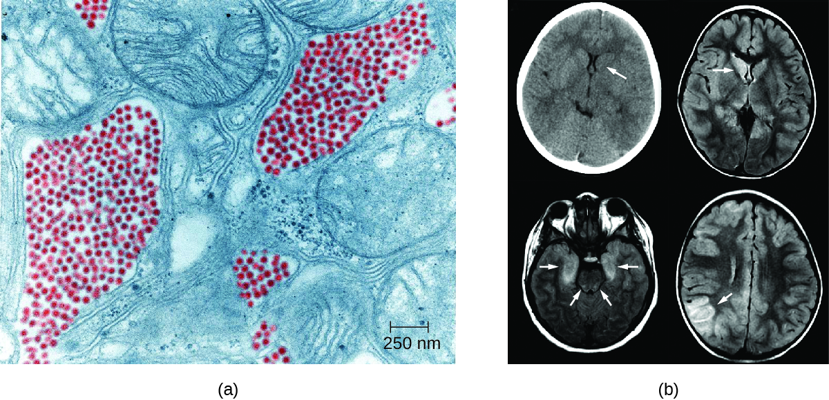 a) electron micrograph showing small red dots next to larger cellular structures. B) brain scans with arrows pointing to dark regions in the brain.