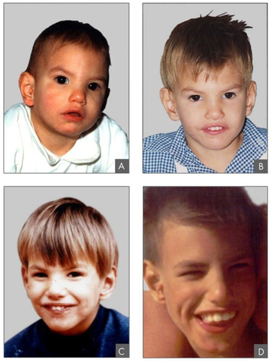 La foto muestra a un niño con síndrome cri-du-chat a cuatro edades diferentes (dos, cuatro, nueve y doce años).