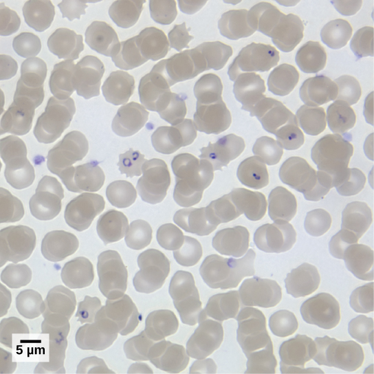 The light micrograph shows round red blood cells, each about 8 microns across, infected with ring-shaped P. falciparum.