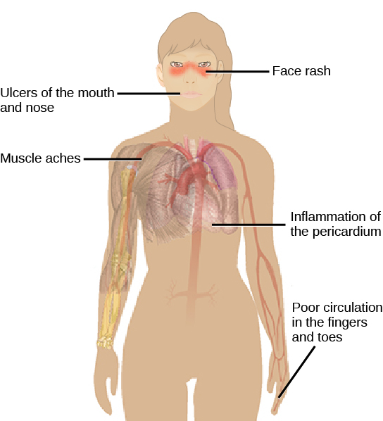 Illustration shows the symptoms of lupus, which include a distinctive face rash across the bridge of the nose and the cheeks, ulcers in the mouth and nose, inflammation of the pericardium, muscle aches and poor circulation in the fingers and toes.